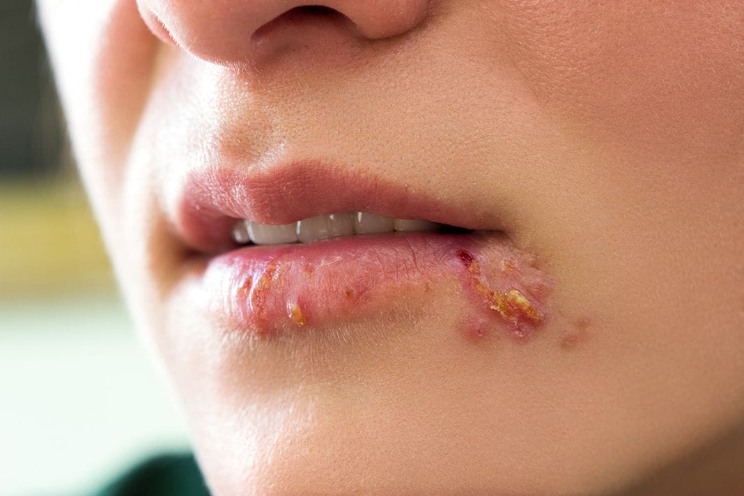 Is Herpes Curable? Yes!